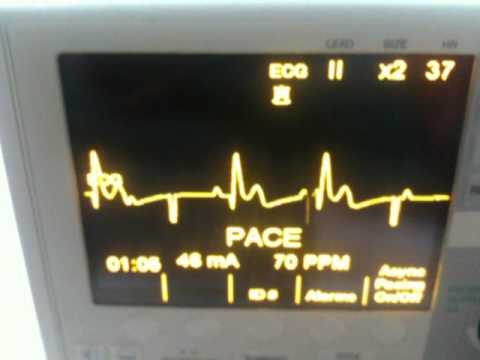 how to treat 3rd degree heart block