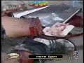 Part 2: after tear gas bombs, lost legs and injured crowd