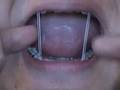 Dueling Braces