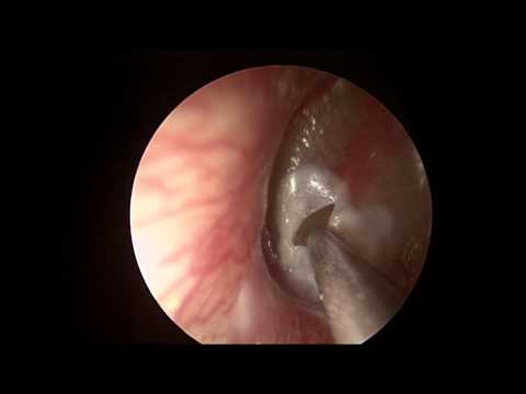 how to drain otitis externa
