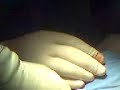 Cirug�a de Fractura Epifisiaria de Radio