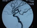 Coil embolization of aneurysm