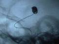 Coil embolization of aneurysm