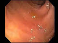 Diverticulosis