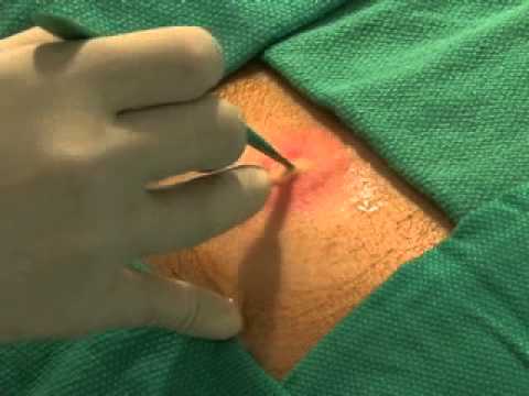 PERIANAL ABSCESS - for medical interns and fresher medical doctors.