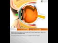 Hyperopia 3D: Quantel Medical