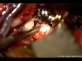 Cotton-Clipping Technique to Repair Intraoperative Aneurysm Neck Tear Video 2
