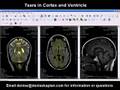 Tears in Cortex and Ventricle