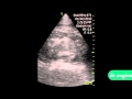 Perirenal Hematoma Perirenal Hematoma