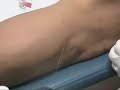 Technique for Popliteal/Peroneal Nerve Block