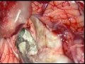 brain tumor -cerebellar dermoid-micrsurgical total excission-dr suresh dugani/HUBLI/INDIA