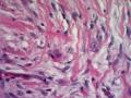 Pseudomesotheliomatous Pulmonary Adenocarcinoma