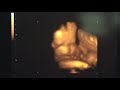 May 3rd 3D ultrasound