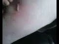 i got bit by a brown resluse (fiddleback) spider