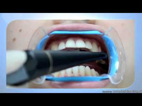 how to whiten teeth stained by tetracycline