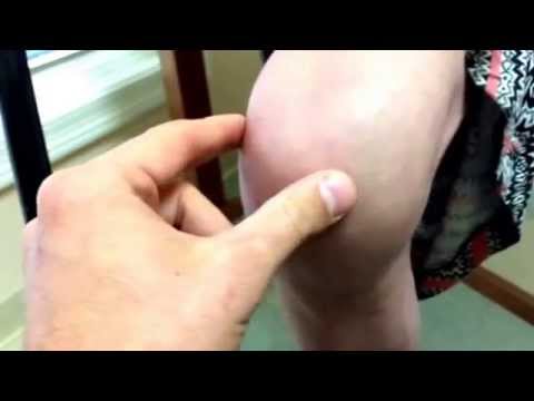 how to treat knee effusion