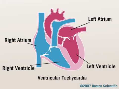 how to treat non sustained v tach
