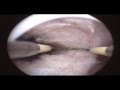 Septum  Prof Dr Bülent Urman www.bulenturman.com