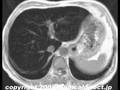 60 year-old man with liver dysfunction.