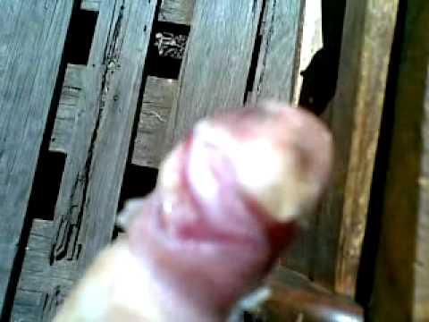 how to treat avulsion