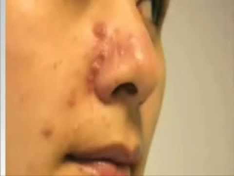 how to heal acne scabs fast