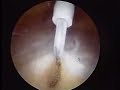 Arthroscopic Trochanteric Bursectomy and IT Band Release