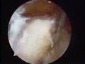 Arthroscopic Trochanteric Bursectomy and IT Band Release