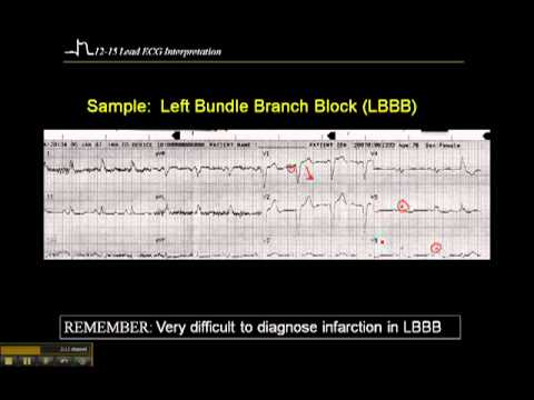 how to treat lbbb