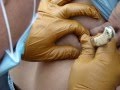 Extreme Gross Cyst operation