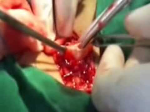 how to cure appendix without operation