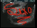Ultrasom Ultrasom