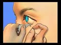 About Lacrisert and Sjogren\ About Lacrisert and Sjogren\