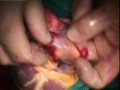 Orthotopic heart transplantation Orthotopic heart transplantation