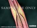Heart Animation: Coronary Artery Angioplasty (Heart Stent)