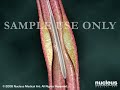 3D Medical Animation: Coronary Artery Angioplasty (Heart Stent)