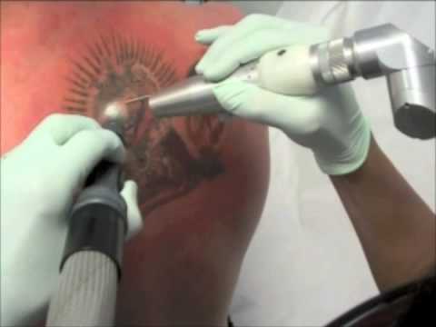 LASER TATTOO REMOVAL - Dr. TATTOFF's OPERATION INK-OFF