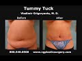 Los Angeles Tummy Tuck by Vladimir Grigoryants, MD Los Angeles Tummy Tuck by Vladimir Grigoryants, MD
