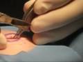 CYST REMOVAL from upper back