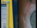 Odstran?ní brýlí femtosekundovým laserem VisuMax (NeoLASIK) na o?ní klinice NeoVize v Brn? Odstran?ní brýlí femtosekundovým laserem VisuMax (NeoLASIK) na o?ní klinice NeoVize v Brn?