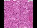 Histopathology Kidney--Renal cell carcinoma (hypernephroma) Renal Cell Cancer