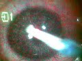 oog laseren