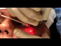 Fraxel Laser Treatment by Dr. Michael Escobedo
