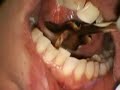 Lingual Frenectomy With Periolase Nd:YAG laser Lingual Frenectomy With Periolase Nd:YAG laser