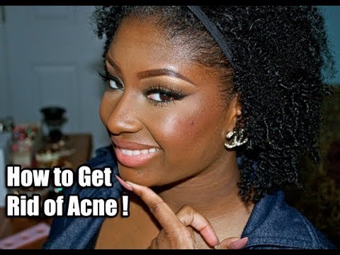 how to use witch hazel for acne