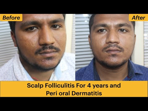 Scalp Folliculitis For 4 years and Peri oral Dermatitis Homoeopathic Cure