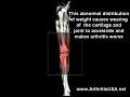Genu Varus or Bowlegged knees by Farshchian Genu Varus or Bowlegged knees by Farshchian