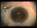Tecnis Multifocal Acrílica - Técnica de Inserción Tecnis Multifocal Acrílica - Técnica de Inserción