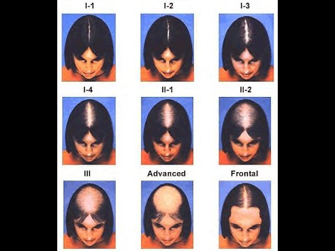 how to treat alopecia