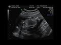 Savarese Baby Ultrasound