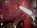 Robotic Microsurgical Tube Reversal --by Dr. Suresh Thani